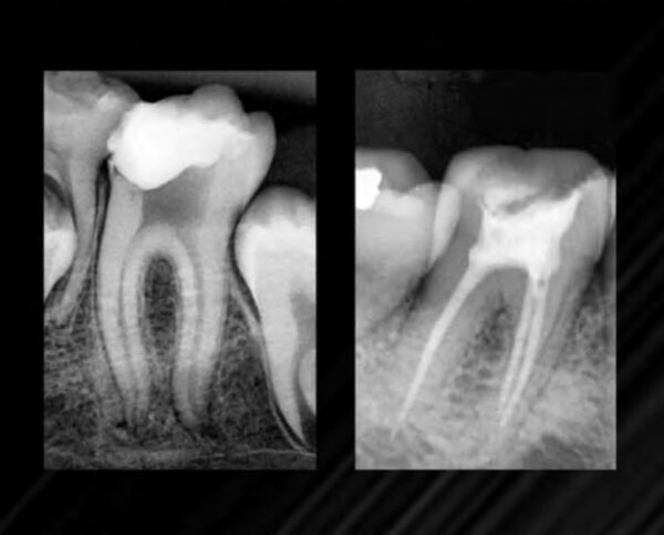 Cemento dual sellador Endosealer Plus Maquira-2